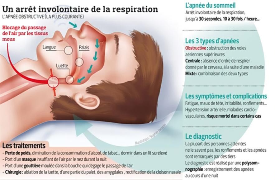 Apnée du sommeil Douai 59